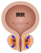 デュタステリド