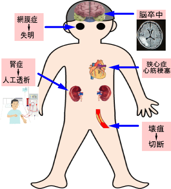 合併症の詳細