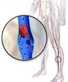 深部静脈血栓症(DVT)