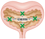 過活動膀胱