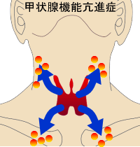 甲状腺機能亢進症　画