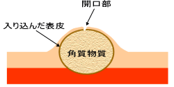 粉瘤(アテローマ)のシェーマ