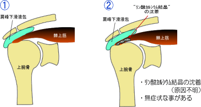 石灰沈着性腱炎の発症