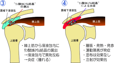 石灰沈着性腱炎の経過