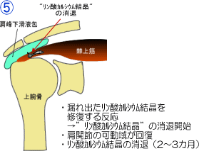 石灰沈着性腱炎の治癒過程