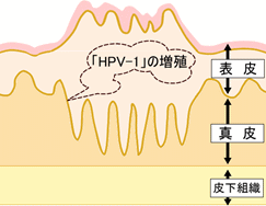 疣贅のしくみ